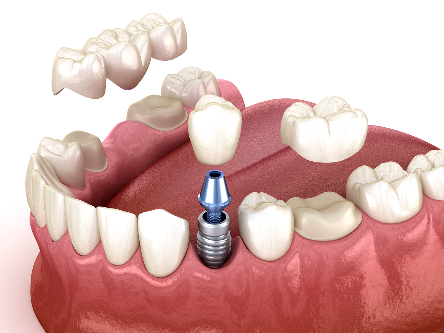 Individuell angefertigte Zahnprothese