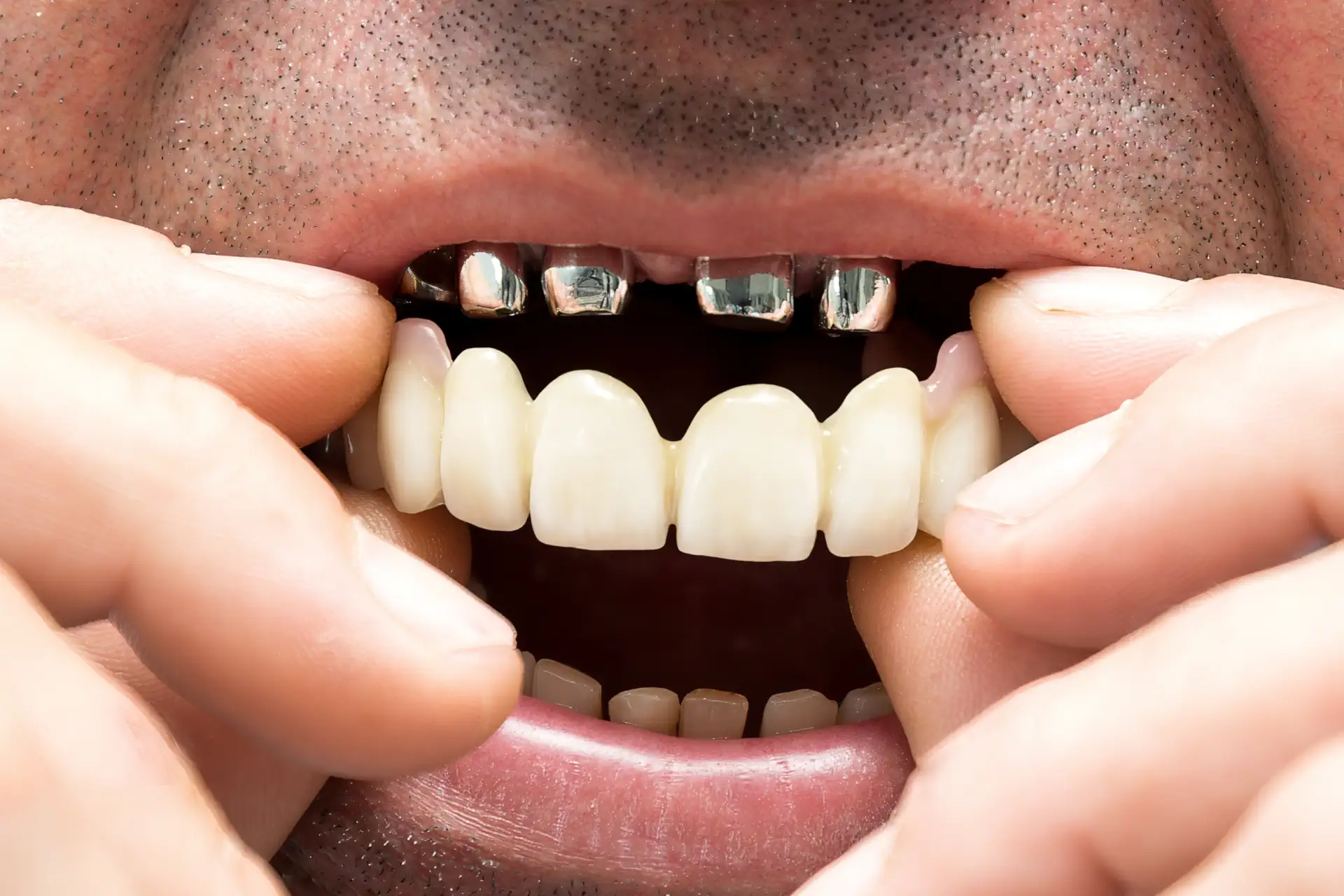 Teleskopprothese mit Doppelkronensystem