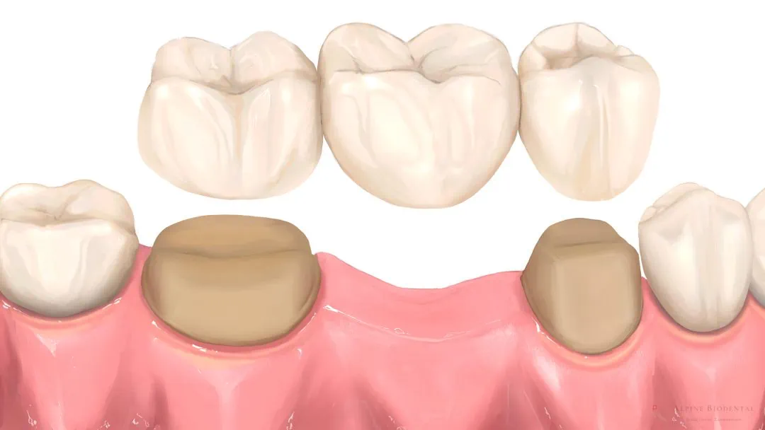 Hochwertige Vollkeramikkrone